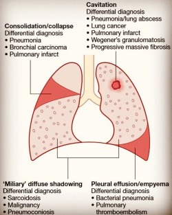 doctordconline: Some of lungs pathology and their localization…  #pathology  #lungs #chest  #anatomy #xray  #radiology #usmle #anatomy #usmlestep1 #tb #doctor #doctordconline #nhs #nurse #nursing #hospital #patient #mbbs #md #medicine @doctordconline