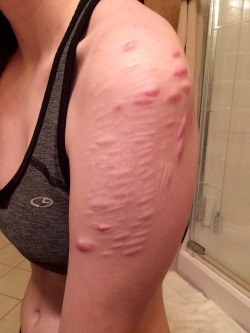 Here&rsquo;s my scars for the person who asked