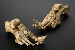 Skeleton showing the effects of leprosy, Netherlands [?], 1250-1500: The right and left feet show the devastating effects of leprosy on the bones of the body. This erosion and damage, caused by the decay of protective fatty tissue, does not occur in all