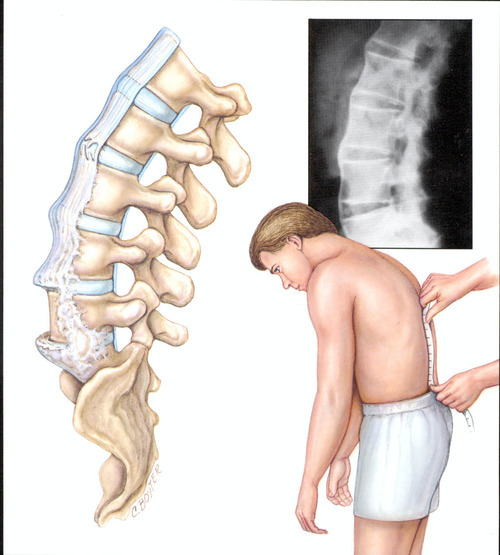 spondylolisthesis, orthopaedic surgeon, surgery, Spondylolisthesis Treatment, Spondylolisthesis Treatment Atlanta, Spinal Osteoarthritis Treatment, Spinal Stenosis Relief