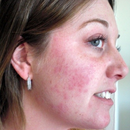 Red itchy rash on face