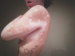 nsfwpale:  prozac-panda:  alxhrta:  I got happiness on my side; literally.  As someone who also suffers from some sort of skin condition, I find this absolutely beautiful. Ab-so-lutely b-e-a-utiful &lt;3   