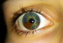 sixpenceee: In sectoral heterochromia one part of the eye is different from it’s remainder. Heterochromia, in general is the result of excessive pigment. It can be inherited or caused by disease &amp; injury.  