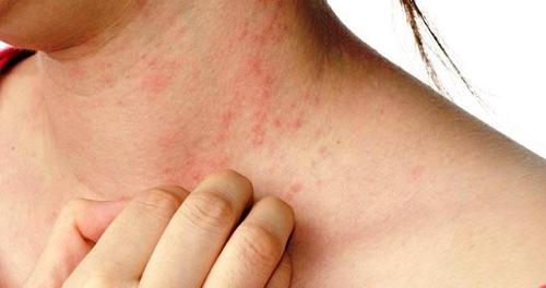 Hives allergic reaction skin rash