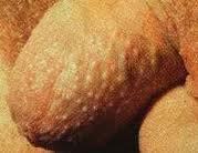 Red spots on penis head