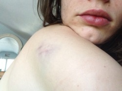 somersetnom:  How did I get this bruise? In my sleep? 