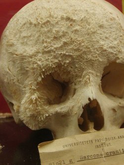 myselfaddictedto:  odditiesandweirdness:  Bone cancer shown on skull  holy shit 