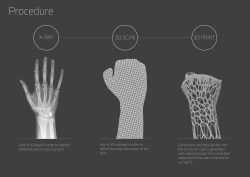 currentsinbiology:  (via CORTEX - EVILL)  After many centuries of splints and  cumbersome plaster casts that  have been the itchy and smelly bane of millions of children, adults and  the aged alike, the world over, we at last bring fracture support into