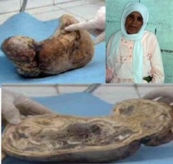Zahra Aboutalib, Morocco, carried her child in her womb for almost half a century. Lithopedion, calcified fetus.