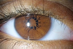 Persistent pupillary membrane (PPM) is a condition of the eye involving remnants of a fetal membrane that persist as strands of tissue crossing the pupil.