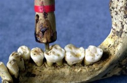 The Indus Valley Civilization has yielded evidence of dentistry being practiced as far back as 7000 BC. This earliest form of dentistry involved curing tooth related disorders with bow drills operated, perhaps, by skilled bead craftsmen. The reconstructio