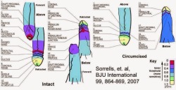 thomas-circ-jock:  bewarethemonsters:  Uncut implies circumcision is normal and acceptable, use intact and cut/circumcised to describe a penis. Stop acting like cutting off 85% of the nerve endings while removing the equivalent to the clitoris is ok.
