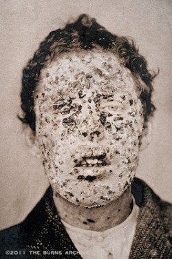 THE BURNS ARCHIVE CIVIL WAR EXHIBITION - SMALLPOX NY CITY EPIDEMIC. Victims of the smallpox epidemic in 1881. More people died from smallpox than any other disease in history.