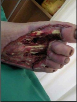 Mercury Exposure from CFL Bulb Foot Injury