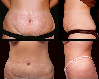 Liposuction back fat bra