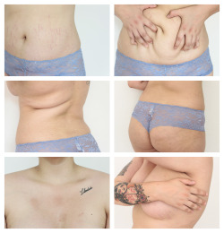 artisalwaysbetterthansadness:  stretchmarks. self harm scars. fat. rolls. cellulite.  skin. 