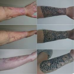 accio-aj:  *warning ⚠ the 3rd photo set is very graphic*  Some up to date comparison pics of my arm graft from phalloplasty.  Pic 1 - 8 months post op vs now a month off 3 years post op Pic 2 - 8 weeks post op Pic 3 - 2,3,5,6 weeks post op.  I’ve