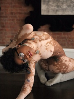 imthewritersway:  A cutie with Vitiligo. Beauty comes in all shades guys and this girl is gorgeous.