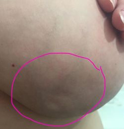 rosezeee: micdotcom:  Don’t scroll past this. Kylie Armstrong was diagnosed with breast cancer and these small dimples were the only signs. She posted the image on Facebook so everyone knows that “that breast cancer is not always a detectable lump.”
