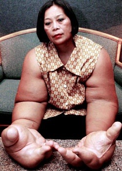Oversized hands and arms, caused by a hormone imbalance.