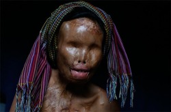The face of Sokreun Mean, who was blinded and disfigured by an acid attack. Carsten Stormer, a German journalist &amp; photographer said, “Acid attacks deprive people of more than their looks and sight. Families are torn apart. Husbands leave their