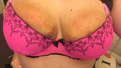 mysubdiary:  Bruise update.  Beautiful boobs. With and without the bruising.