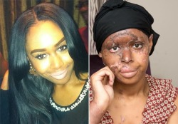 youngblackandvegan:   eclecticdreamer:  therealleaah:  My prayers go out to the beautiful Naomi Oni I have been looking up things about this all day today a “friend” of hers threw acid on her face because she was jealous of her smh  WOW  so sad 