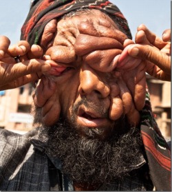Man with no face and rare disease in Kashmir