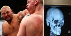 bleacherreport:  UFC fighter Stefan Struve shared his X-rays of his broken jaw from his latest fight against Mark Hunt. Ouch.h/t Yahoo! Sportsvia https://twitter.com/StefanStruve