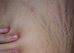 fatgirlsdoingthings:    futuredoctorweirdo:  On my last rotation we were prepping a patient for surgery who had a lot of stretch marks (which is very common, of course). The doctor said, “look closely at them, they’re beautiful.” She was right…inside
