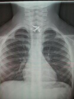 fondest:  l4mbie:  cuntherine:  i-d-come-for-you:  rautical:  the-absolute-funniest-posts:  leftbehindtime: a girl swallowed a charm from her necklace and had to go to the emergency room One of the best x-rays ever. Jealous.  I’m going to start swallowing