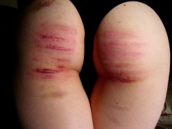 holly-gonightly:  The Caning Diaries: Day 21Thoughts: Now we’re getting somewhere. These frickin’ hurt. Tears came before we even hit 10, and I can tell my ass is getting more sensitive from the accumulated hits, because even the lightest hits are