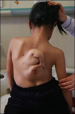 Girl with parasitic twin.