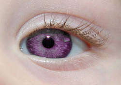 chynaseyes:  huny-bee:  c-lassy:  russian-sins:  Alexandria’s Genesis, a.k.a violet eyes (a genetic mutation). When someone is born with Alexandria’s Genesis, their eyes are blue or gray at birth. After six months, the eyes begin to change from their
