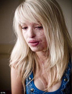  REBLOG IF YOU STILL THINK SHE’S BEAUTIFUL. what happened to her? does anyone mind telling me? A boyfriend or ex boyfriend got jealous and poured petrol over her or something to burn her skin:/ It was some sort of acid. An ex boyfriend and another man