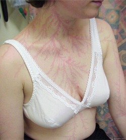  A Body Struck by Lightning  Lichtenberg figures (aka “lightning flowers”) appear on the skin of lightning strike victims. These are reddish, fern-like patterns that may persist for hours or days. They are also a useful indicator for medical examiners