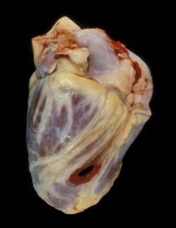  1. Shot in the Heart. 2. Cancer Heart. 3. Teen Drug Overdose Heart.  4. Fatty Oversized Heart.  