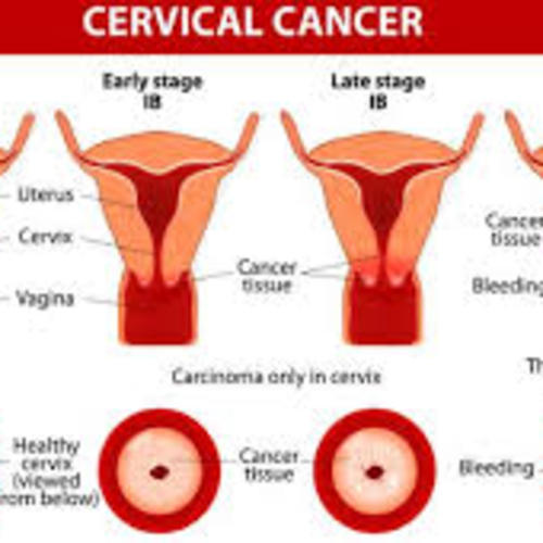 Cervical cancer stages jizz free porn